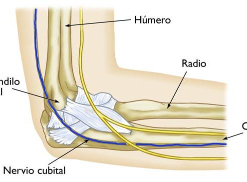 Síndrome del túnel cubital